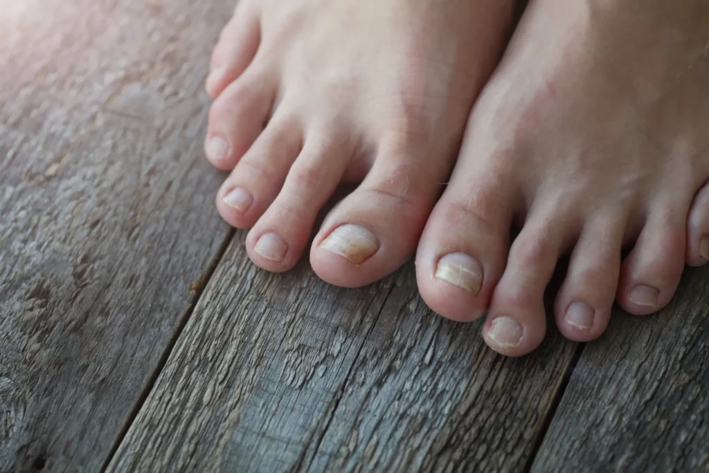 close up of legs with fungus on nails on wooden ba 2023 11 27 05 19 15 utc