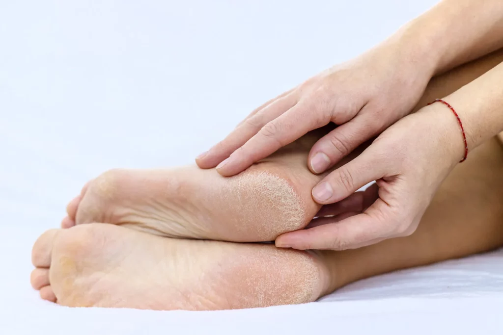 female feet dry skin on the heels selective focus 2023 11 27 04 51 22 utc